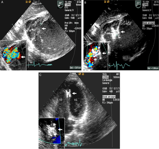 Transcatheter Closure Of A Traumatic Ventricular Septal Defect ...