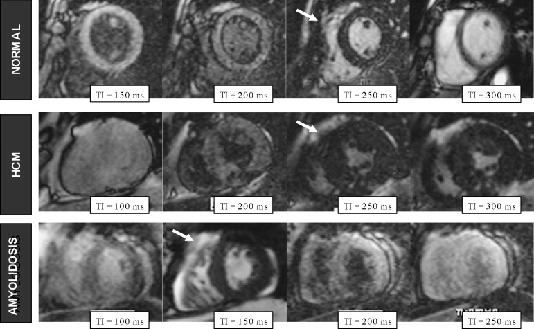 Left Ventricular Hypertrophy: Cardiac Magnetic Resonance May Help ...