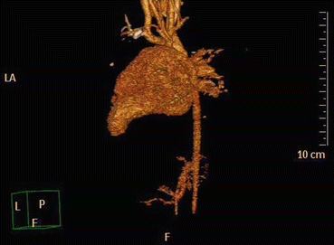 Anomalies Of The Aortic Arch: Aortic Coarctation And Interrupted Aortic ...