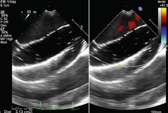 Closure Of Atrial Septal Defect And Patent Foramen Ovale | Thoracic Key