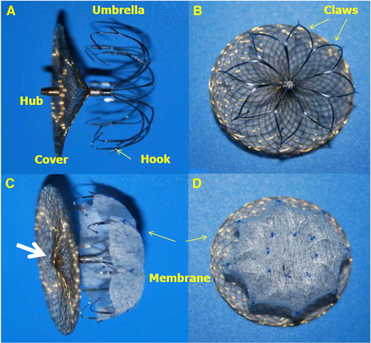 A New Left Atrial Appendage Occluder (Lifetech LAmbre TMDevice) For ...