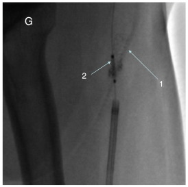 Unusual Complication During A Percutaneous Coronary Intervention For A ...