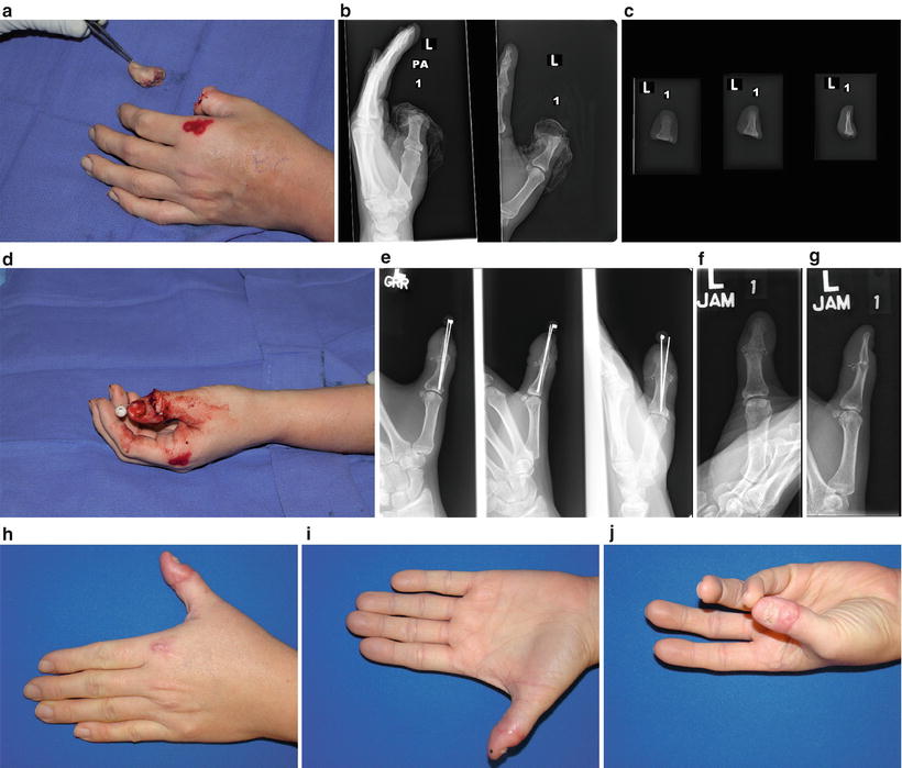 Upper Extremity Amputation | Thoracic Key