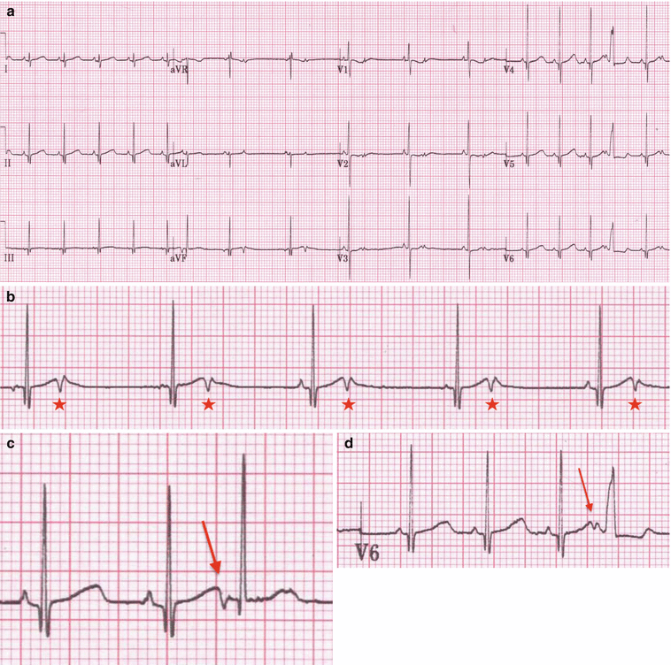 Bradycardias And Conduction Disorders | Thoracic Key