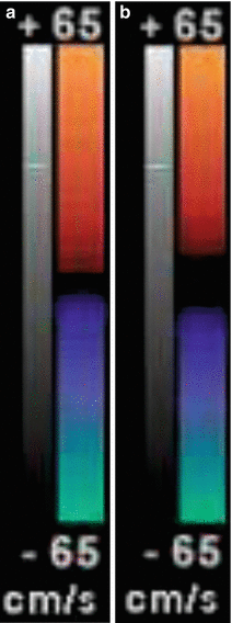 Principles Of Vascular Ultrasound Physics | Thoracic Key