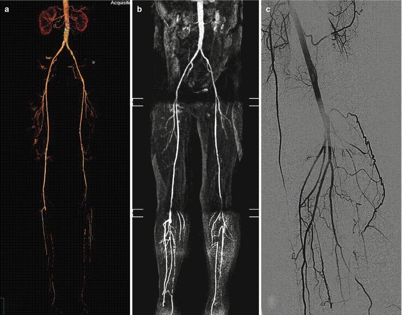 Computed Tomographic Angiography In The Diagnosis Of Peripheral ...