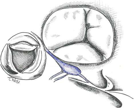 Tricuspid Valve Disease: Surgical Techniques | Thoracic Key