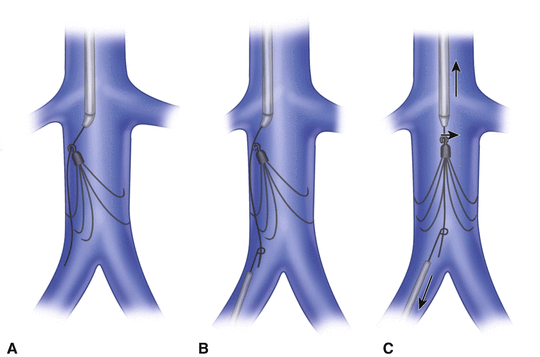 Retrieval Of Inferior Vena Cava Filters | Thoracic Key