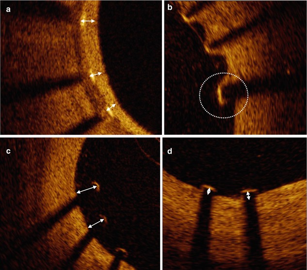 Interpretation Of Optical Coherence Tomography: Quantitative ...