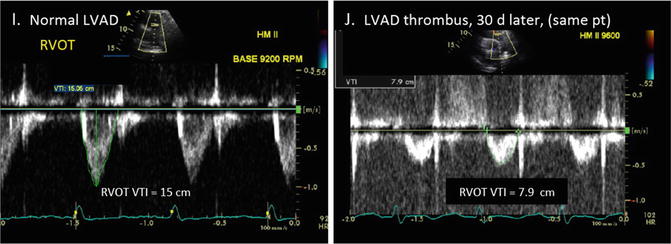 Surveillance Echocardiography For LVAD Patients | Thoracic Key