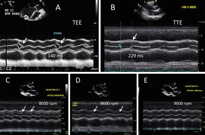 Surveillance Echocardiography For LVAD Patients | Thoracic Key