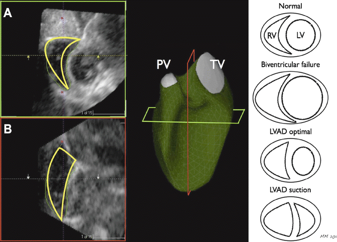 Optimization Of Right Ventricular Function Preoperatively For LVAD ...