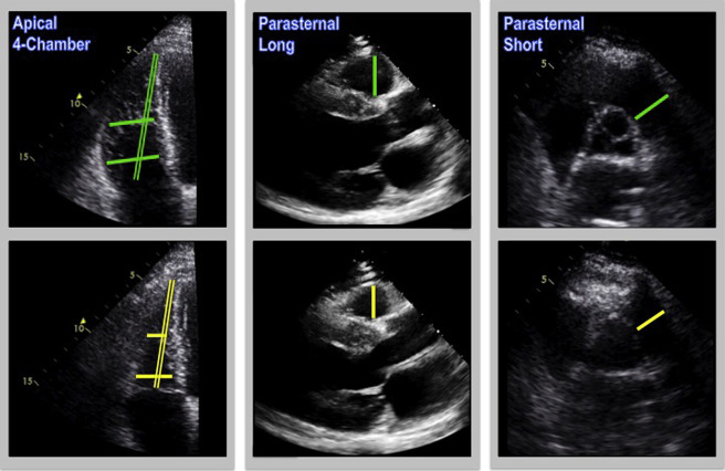 Echocardiographic Linear Dimensions For Assessment Of Right Ventricular ...