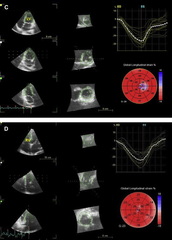 Assessment Of Biventricular Function By Three-Dimensional Speckle ...