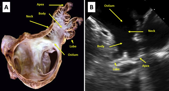 Left Atrial Appendage Occlusion/Exclusion: Procedural Image Guidance ...