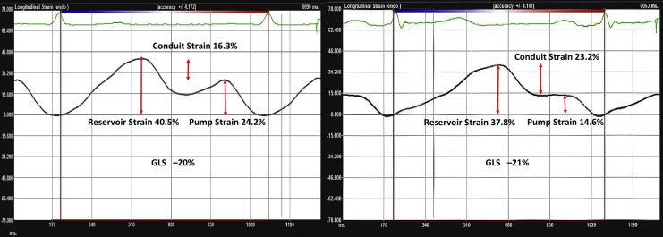 Association Of The Active And Passive Components Of Left Atrial ...