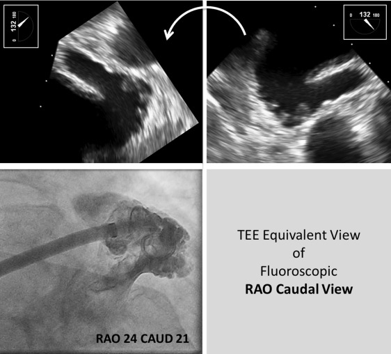 Left Atrial Appendage Occlusion/Exclusion: Procedural Image Guidance ...