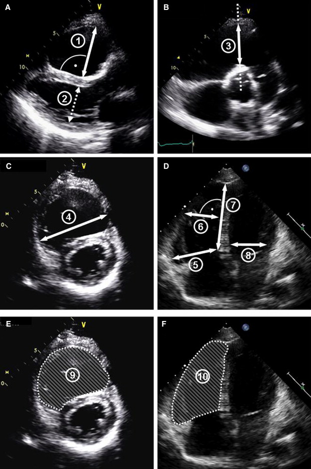 Echocardiography For Assessment Of Right Ventricular Volumes Revisited ...