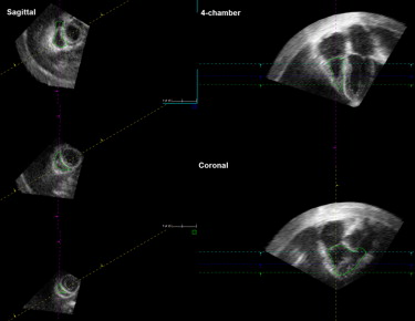 Three-Dimensional Echocardiographic Assessment Of Right Ventricular ...