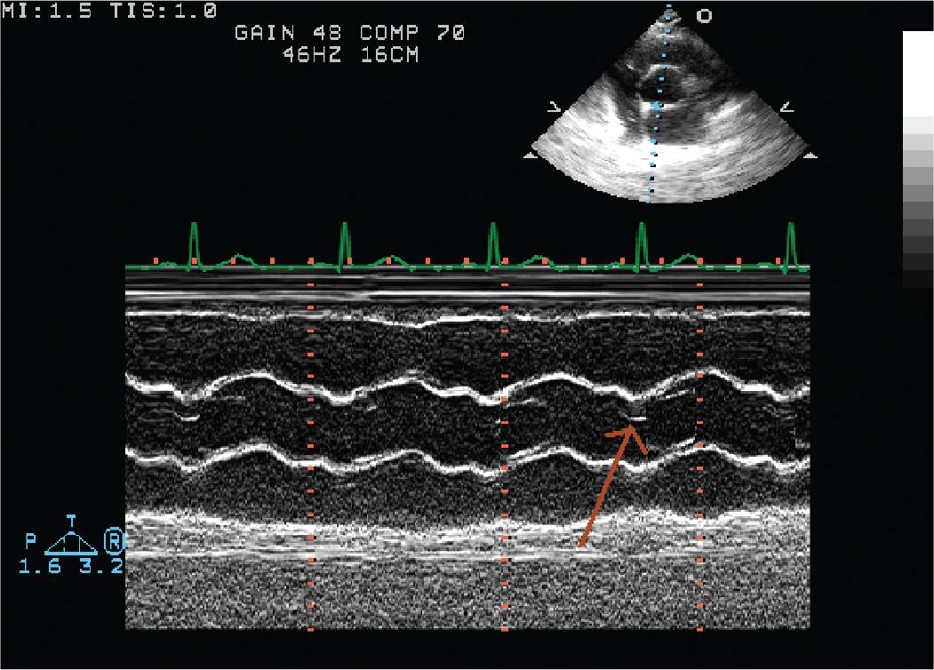 Echocardiographic Assessment Of Valvular Heart Disease | Thoracic Key