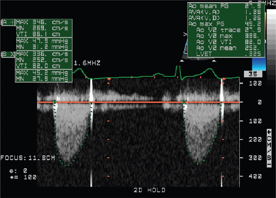 Echocardiographic Assessment Of Valvular Heart Disease | Thoracic Key