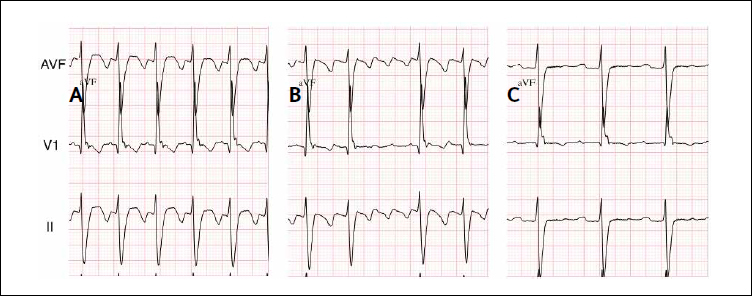 How To Ablate Typical And Reverse Atrial Flutter | Thoracic Key