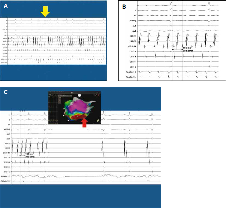 Hybrid Minimal Invasive Epicardial And Transvenous Catheter Ablation ...