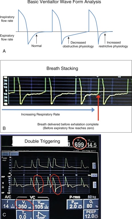 Invasive Mechanical Ventilation | Thoracic Key