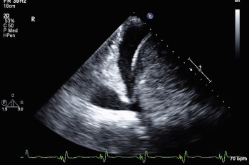 Echocardiography In Heart Failure | Thoracic Key