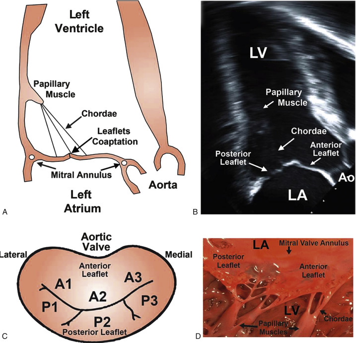 Mitral Valve Disease | Thoracic Key