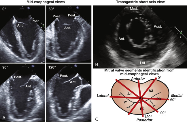 Mitral Valve Disease | Thoracic Key