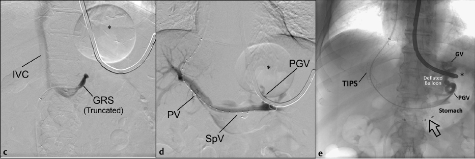 The Conventional Balloon-Occluded Retrograde Transvenous Obliteration ...