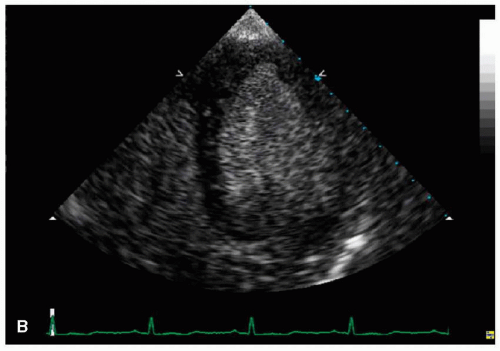 Contrast-Enhanced Ultrasound Imaging | Thoracic Key