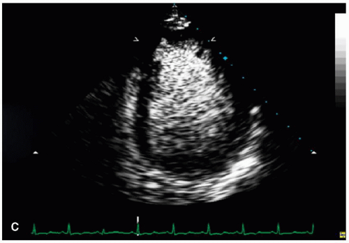 Contrast-Enhanced Ultrasound Imaging | Thoracic Key