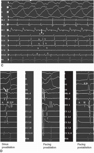 Sudden Cardiac Death And The Cardiac Arrest Survivor | Thoracic Key