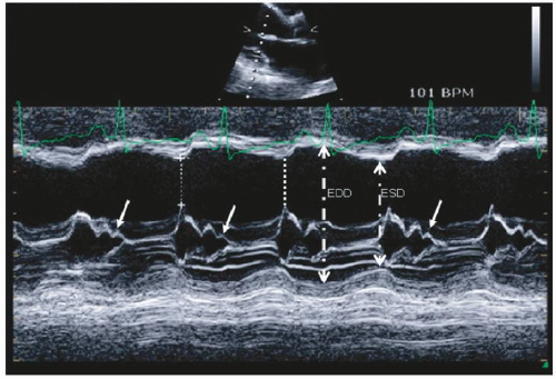 M-Mode Echocardiography | Thoracic Key