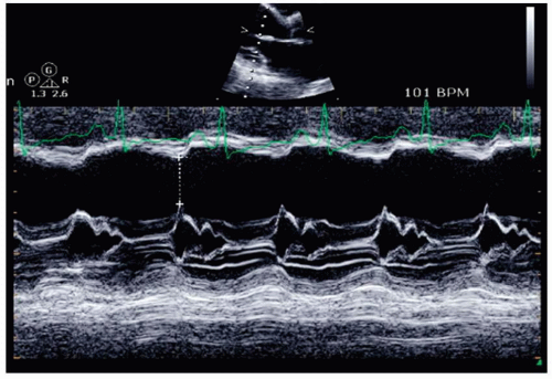 M-Mode Echocardiography | Thoracic Key