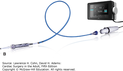 Temporary Mechanical Circulatory Support | Thoracic Key