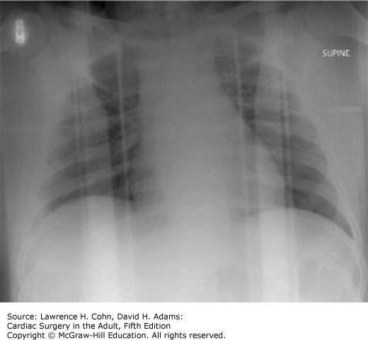 Trauma To The Great Vessels | Thoracic Key