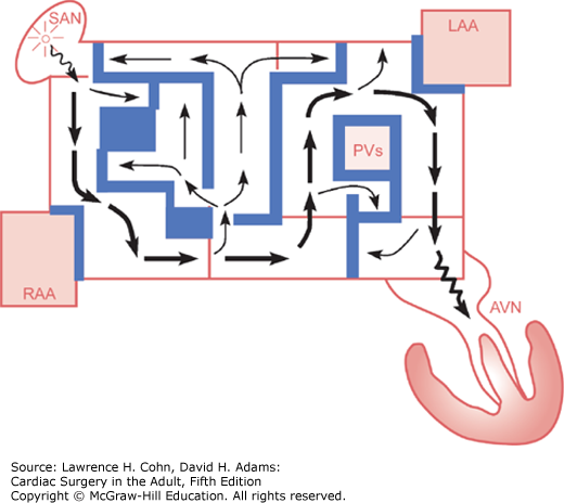 Surgery For Atrial Fibrillation | Thoracic Key