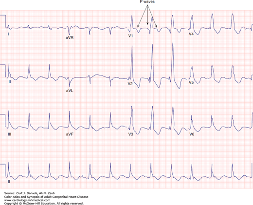 ARRHYTHMIAS IN ADULT CONGENITAL HEART DISEASE | Thoracic Key