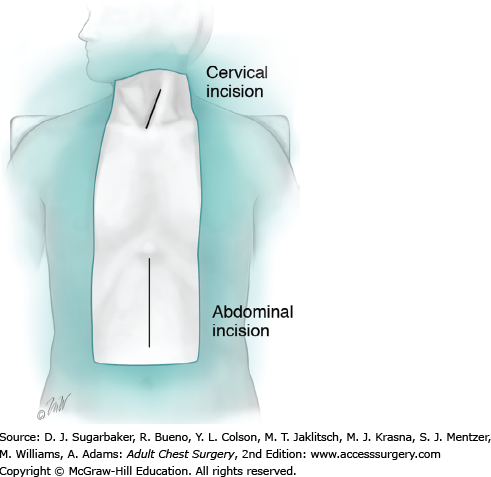 Transhiatal Esophagectomy | Thoracic Key