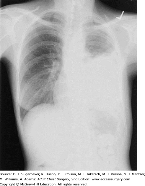 Nonoperative Treatment Of Malignant Pleural Effusions | Thoracic Key