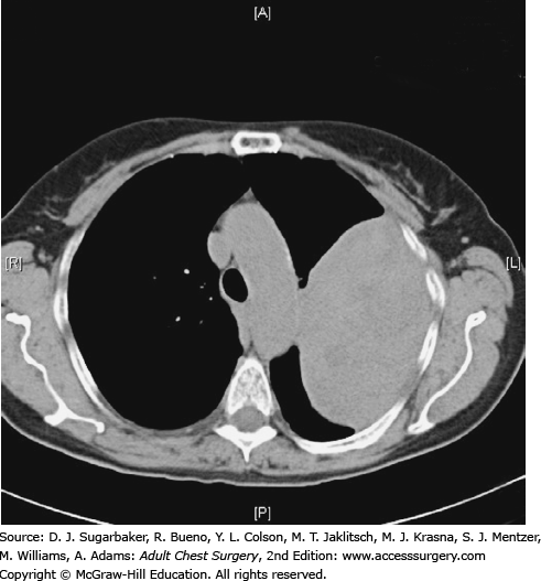 Benign Tumors Of The Pleura | Thoracic Key