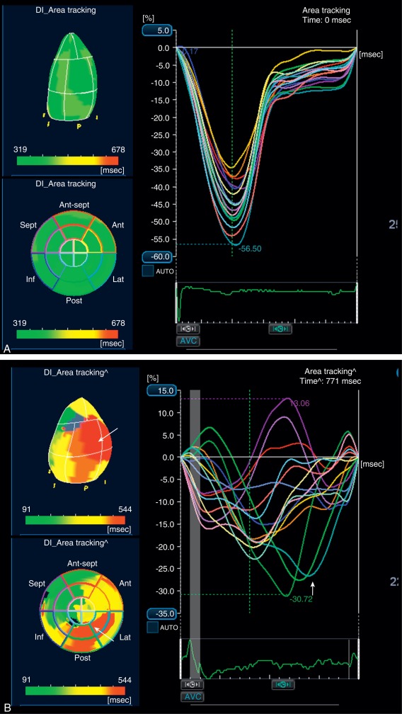 Left Ventricular Systolic Function Thoracic Key