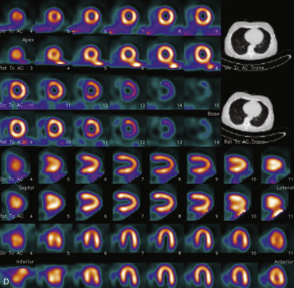 Myocardial Perfusion SPECT/CT: The Added Value Of CT Imaging | Thoracic Key