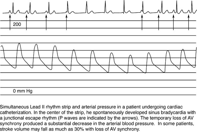 Electronic Pacemakers | Thoracic Key