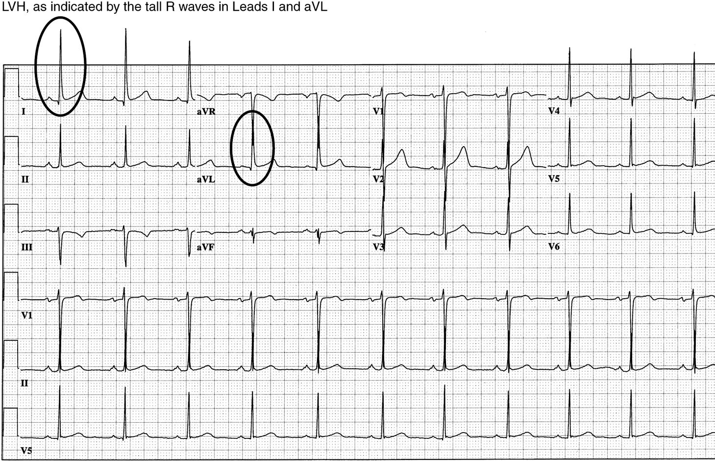 Chamber Abnormalities And Intraventricular Conduction Defects ...