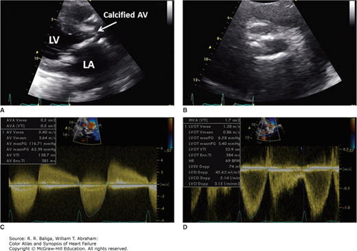 Valvular Heart Disease | Thoracic Key