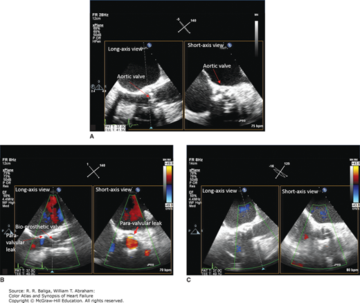 Valvular Heart Disease | Thoracic Key